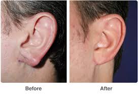 Image result for ear surgery