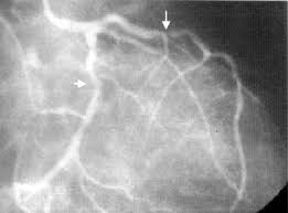 Image result for ‫آنژیوگرافی‬‎