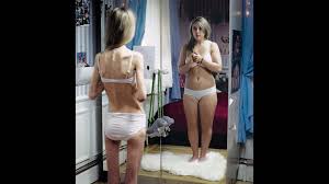 Image result for eating disorder pictures