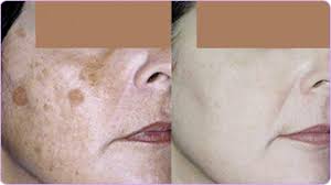 Image result for what is age spots
