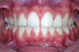 Resultado de imagen de definicion oclusion dental