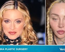Imagen de Madonna before and after plastic surgery