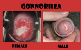 Gonore (Gonorrhea)