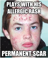 Allergic Rash Alex memes | quickmeme via Relatably.com