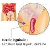 Hernie inguinale Paris, traitement de la hernie de l aine, chirurgie