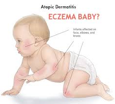 Image result for gambar ekzema pada bayi
