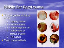 Image result for barotrauma ear