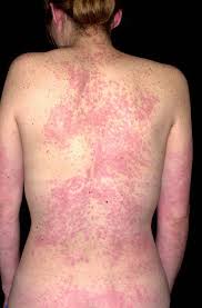 Image result for hives