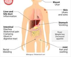 Abdominal pain symptom of Crohn's disease