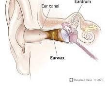 Image of Earwax buildup