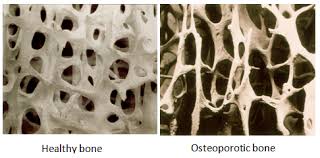 Healthy and Osteoportic Bone