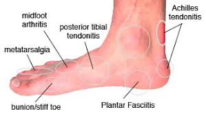Image result for heel injury and pain