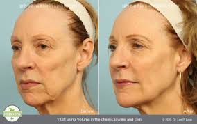 Image result for voluma before and after