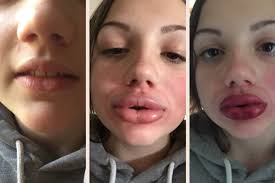 Image result for kylie jenner lip challenge gone wrong pictures