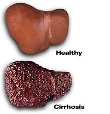 Cirrhosis (Sirosis)