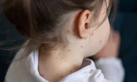 New map exposes measles outbreak as 1,000 cases of Victorian disease recorded in 5 weeks