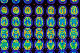 Image result for alzheimer's brain