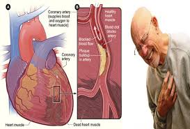 Arteri Koroner (Penyakit Jantung Koroner)