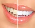 Astuces pour dents blanches