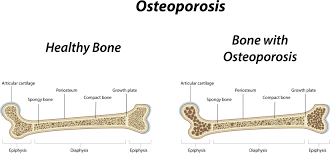 Image result for osteoporosis