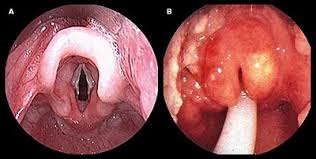 Epiglotiditis