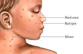 Image result for chicken pox