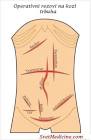 surgical incision